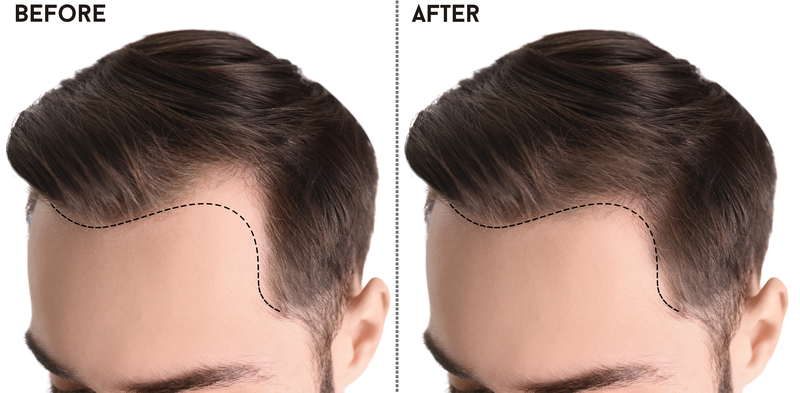 Hair loss treatment before and after